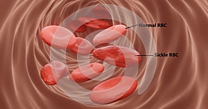 Sickle cell anemia, rbcs in flow in 3d illustration photo