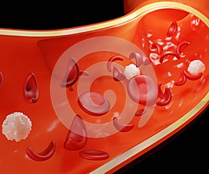 sickle cell anemia, some red blood cells look like sickles photo