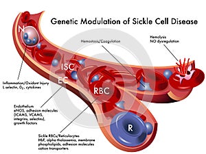 Sickle cell disease