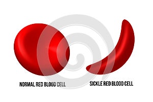 Sickle cell disease. The difference of Normal red blood cell and sickle cell.