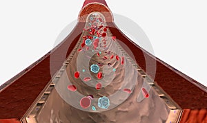 Sickle cell disease is a disease characterized by atherosclerosis and insufficient oxygen to body tissues