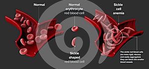 Sickle cell disease is a group of blood disorders. Sickle cell anaemia. photo