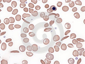 Sickle cell disease, peripheral blood.