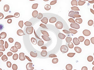 Sickle cell disease, peripheral blood.