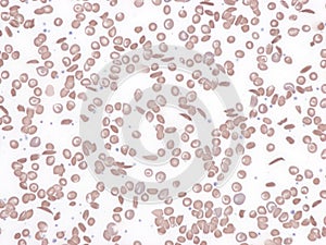 Sickle cell disease, peripheral blood.