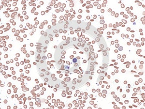 Sickle cell disease, peripheral blood.