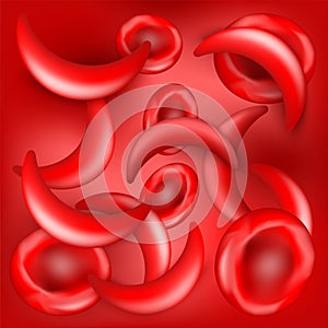 Sickle cell disease. SCD. red background. Anemia or anaemia