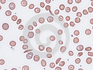 Sickle cell disease. photo