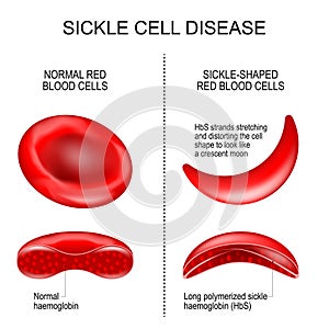 Sickle cell disease photo