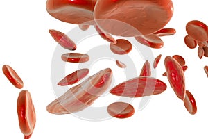 Sickle cell and normal red blood cells