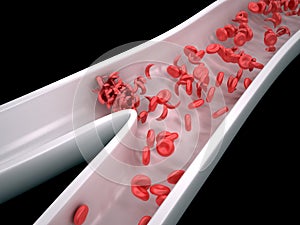 Srp buňky blokování krev průtok 