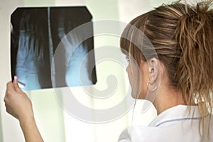 Sickness. Female doctor examining an x-ray photo