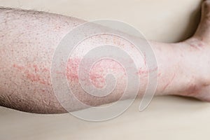 Side of male shin with itchy red rash