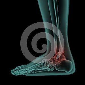 Side x-ray view of human painful foot and ankle