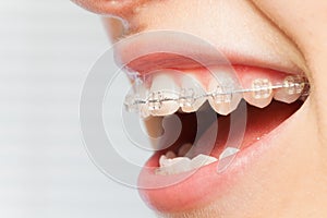 Orthodontics correction of jaws with clear bracket photo
