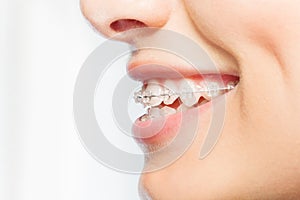 Side view picture of woman smile with clear braces photo