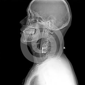 Side X-ray picture of head and neck