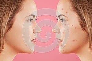 Sideways shot of two female`s faces: one with healthy pure skin and other with many pimples, has acne, constrast bewtween healthy