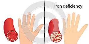 Sign of chronic iron deficiency yellow skin