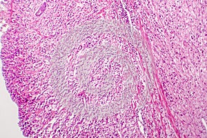 Signet ring cell carcinoma