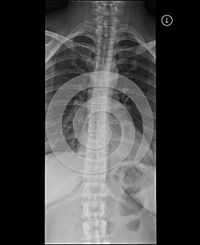 Thoracic spine x-ray. Anteroposterior view. photo