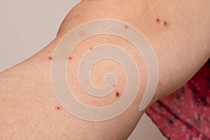 Signs of chicken pox on a woman's leg. Red crusts of pustules
