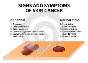 Známky a príznaky z kože rakovina 
