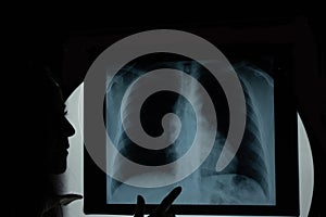 Post anterior chest X-ray showing lung parenchyma homogeneous radiographic pattern and aortic button prominence reviewing by photo