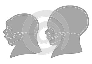 Silhouette image of the head and skull of a newborn child with a normal cranium and with microcephaly and severe microcephaly.