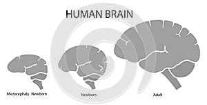 Silhouette image of human brain adult, newborn child with a normal brain and severe microcephaly. Virus of Zika.  Flat design
