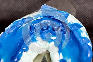 Silicone tooth print for the manufacture of a blue tooth pin and tooth crown. Restoration of a manâ€™s smile in a dental clinic