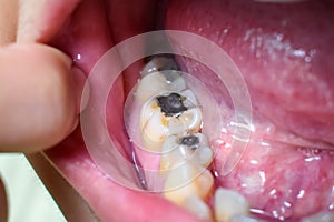 Silver amalgam fillings at right lower first molar and left lower second premolar teeth in Asian, young man. poor oral hygiene photo