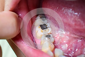 Silver amalgam fillings at right lower first molar and left lower second premolar teeth in Asian, young man. poor oral hygiene