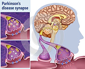 Sinapsis de Dopamina en el mal de Parkinson