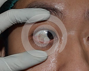 Single eyelid or monolid of Asian man. Eye health and care