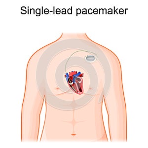 Single lead pacemaker placement. Cross section of heart and artificial cardiac pacemaker