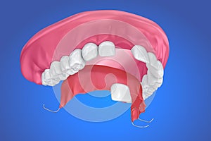 Single Missing Tooth - Removable partial denture