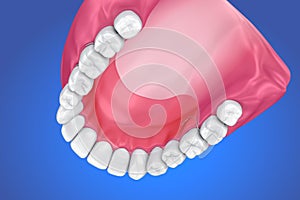 Single Missing Tooth - Removable partial denture