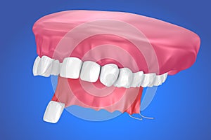 Single Missing Tooth - Removable partial denture