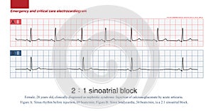 2 to 1 sinoatrial block