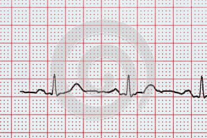 Sinus Heart Rhythm On Electrocardiogram Record Paper Showing Normal Heart