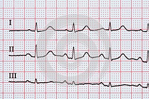 Sinus Heart Rhythm On Electrocardiogram Record Paper Showing Normal Heart