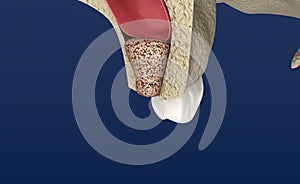 Sinus Lift Surgery - Sinus Augmentation. illustration photo