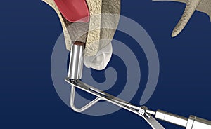 Sinus Lift Surgery - Sinus Augmentation. illustration photo