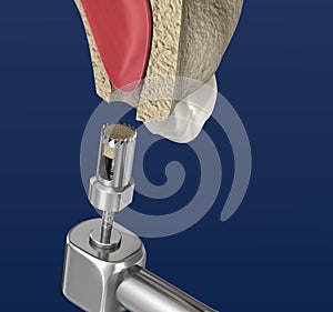 Sinus Lift Surgery - Sinus Augmentation. illustration photo