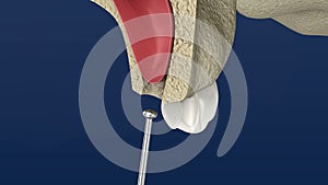 Sinus Lift Surgery - Sinus Augmentation.