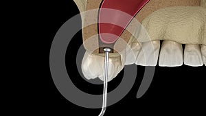 Sinus Lift Surgery - Sinus Augmentation