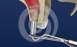 Sinus Lift Surgery - Sinus Augmentation. illustration