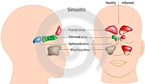 Sinusitis