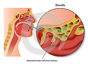 Sinusitis